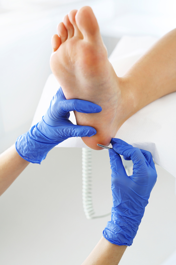 Podiatry. Removing calluses with a scalpel at the beautician.